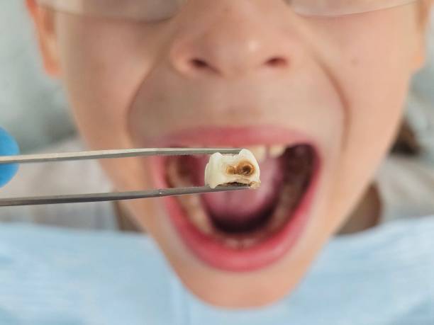 Best Emergency Dental Extractions in Anderson, CA
