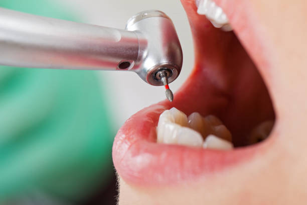 Best Emergency Dentist for Lost Fillings or Crowns in Anderson, CA